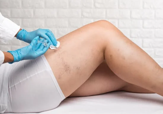 Spider Vein Treatment